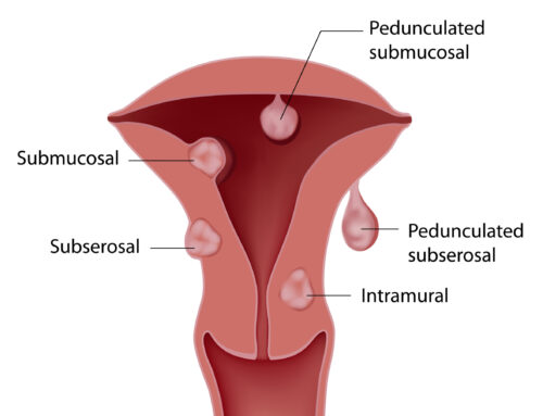 Uterine Fibroids and How Our Doctors Help You Manage Them